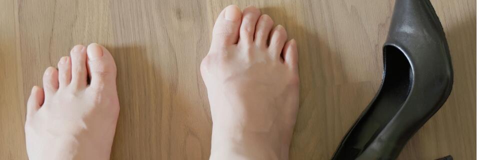 C_Hallux_Valgus.jpg